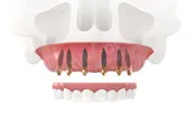 All-on-6 – имплантация всех зубов