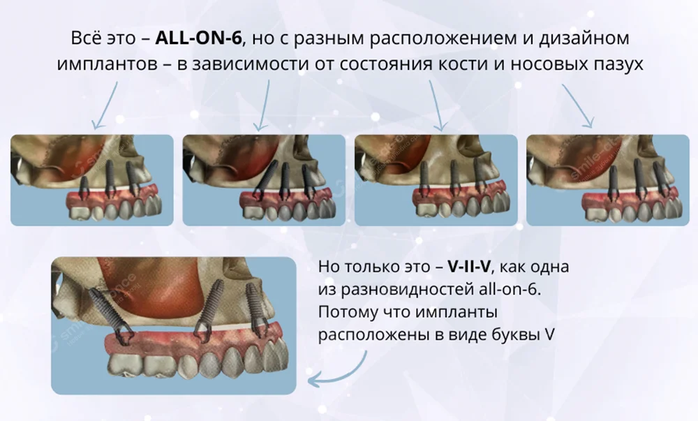 Виды имплантации зубов All-on-6