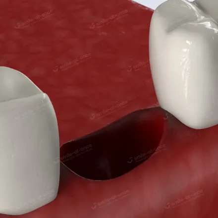 Лечение альвеолита лунки зуба