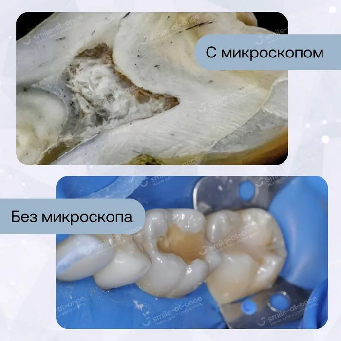 процесс лечения зубов под микроскопом