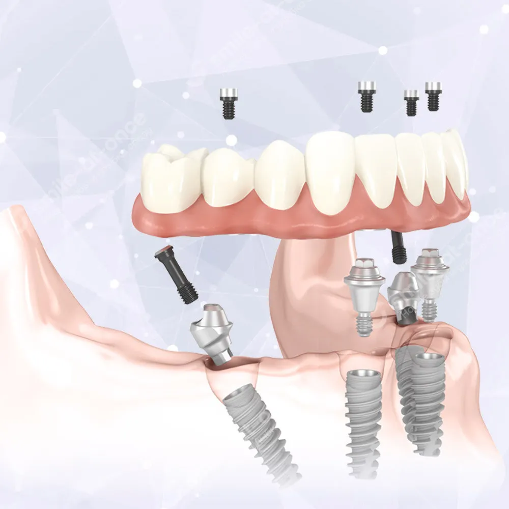 Применение зубных имплантов Nobel Biocare