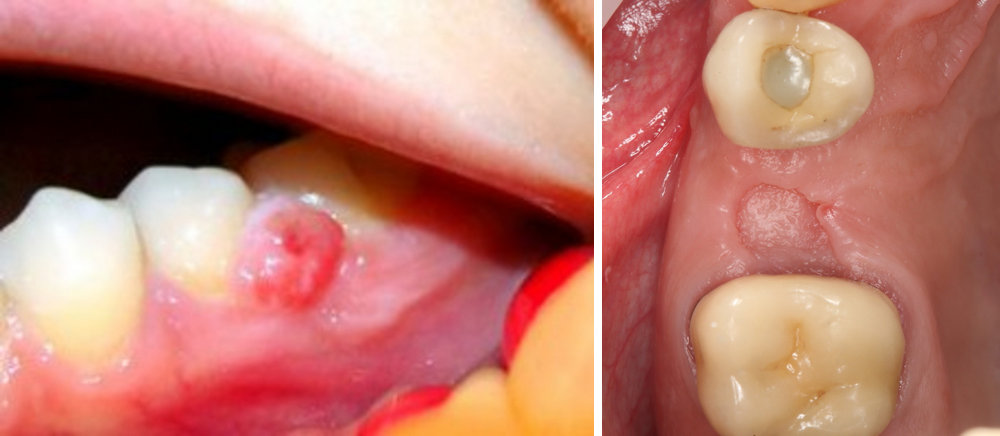 Возможные осложнения кисты и гранулемы зуба