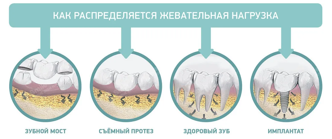Распределение нагрузки на зубы