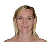 Ольга до проведения имплантации зубов