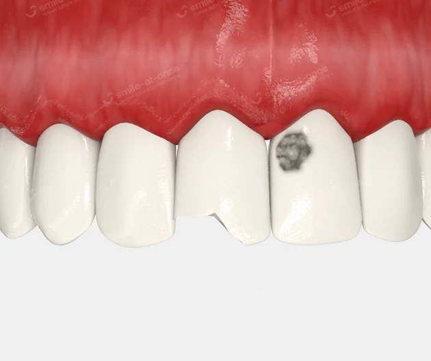 Сколы и трещины зубов