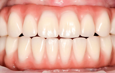 Фото зубов после комплексной имплантации