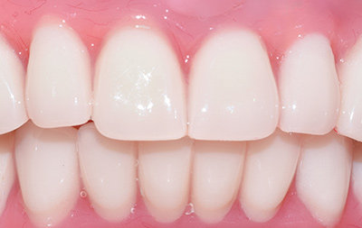 Восстановление зубов с использованием протокола комплексной имплантации