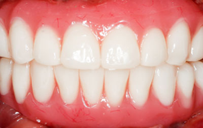 Полное восстановление зубов на 2-х челюстях
