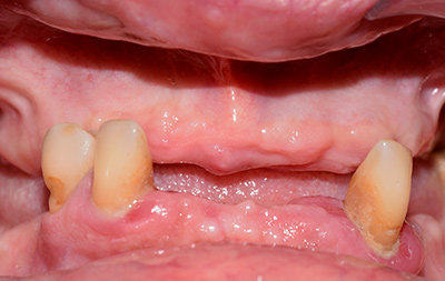 Практически полное отсутствие зубов на обеих челюстях