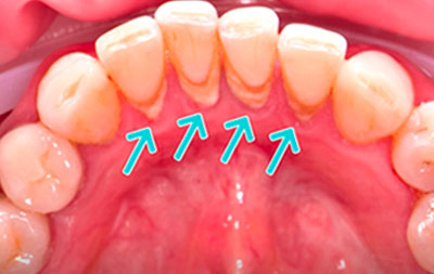 Зубной камень на нижней челюсти