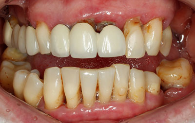 Фото до скуловой имплантации зубов