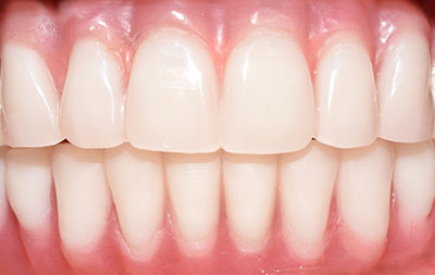 Удаление подвижных зубов и одномоментная установка односоставных имплантов