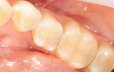 Проведено терапевтическое лечение 5 жевательных зубов