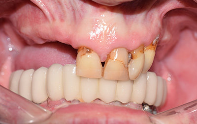 Почти полное отсутствие зубов и атрофия кости на верхней челюсти
