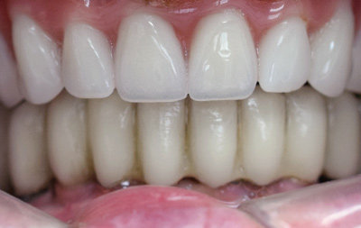 Восстановление зубов на верхней челюсти