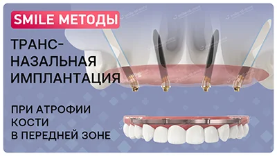 Видео о трансназальной имплантации зубов