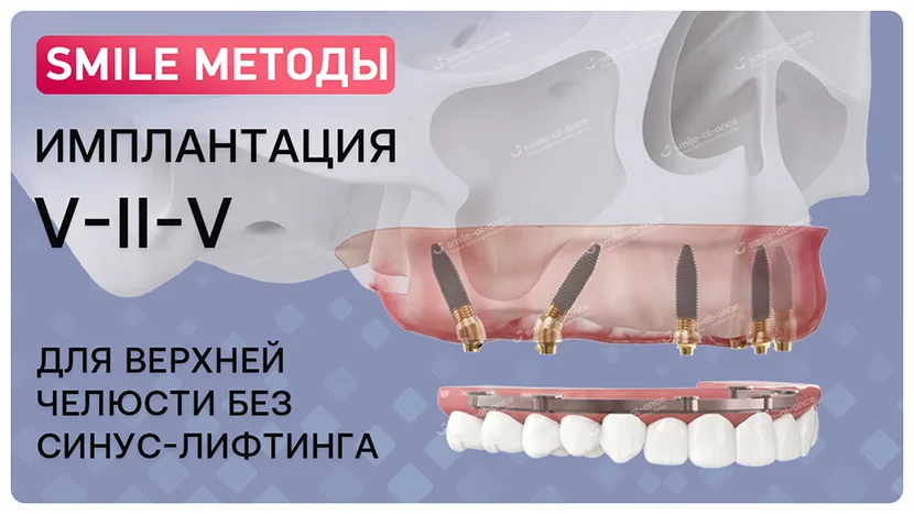 Имплантация зубов V-II-V без синус-лифтинга