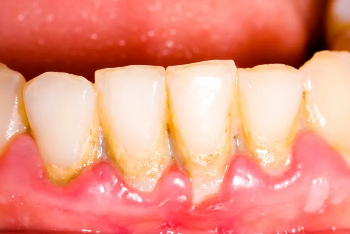 Фото: зубного камня у пациента