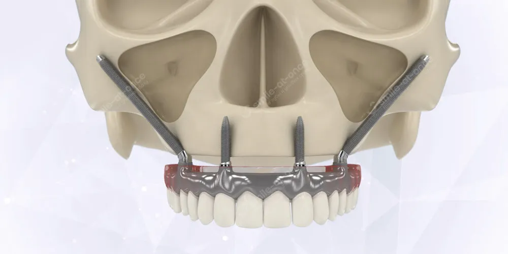Скуловая имплантация зубов Zygoma от компании Nobel