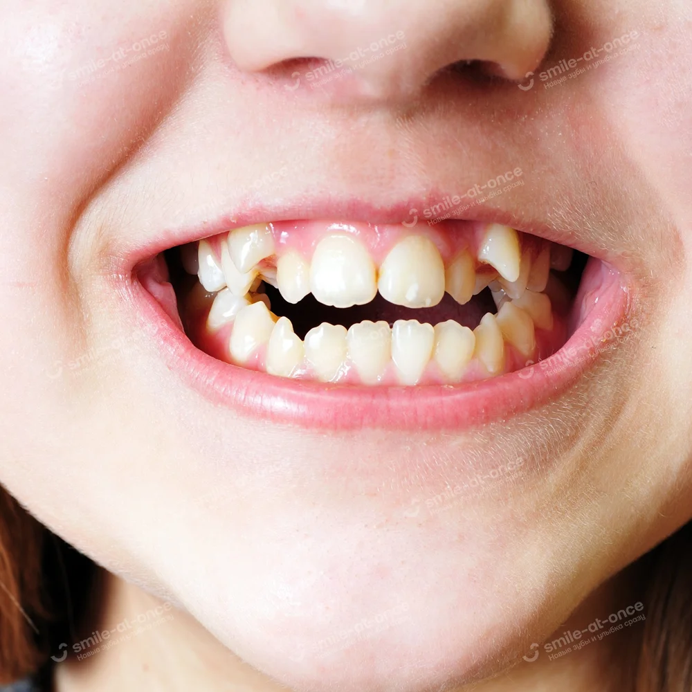 искривление зубов