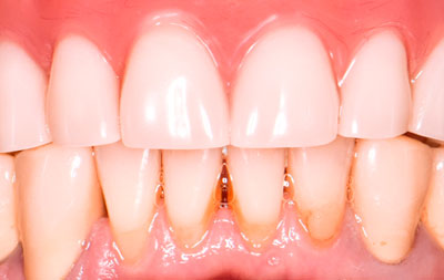 восстановление зубов 