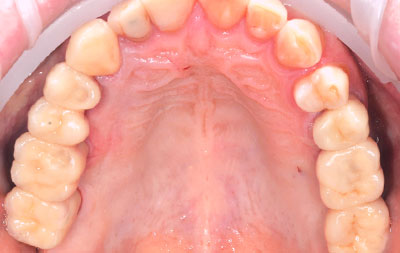 Фото после имплантации верхних зубов