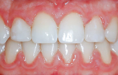 Ровные зубы после лечения