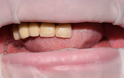 Полное отсутствие зубов на нижней челюсти и частичное на верхней