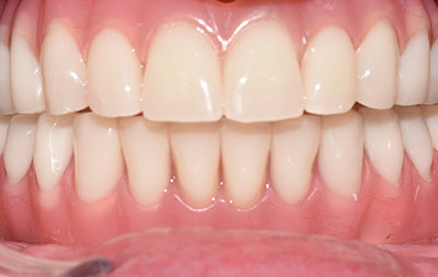Протезирование зубов по комплексному протоколу