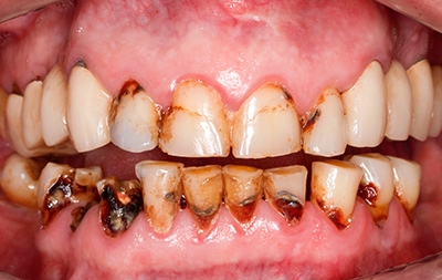 Патологическая стираемость зубов, хронический пародонтит, разрушение зубов до корней