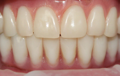 Проведено восстановление зубов 