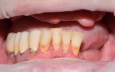 Отсутствие зубов и атрофия костной ткани