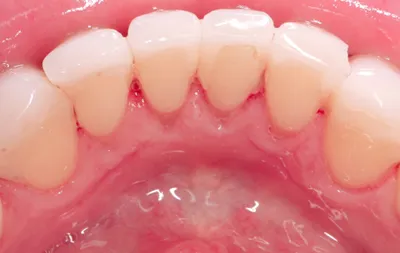 Фото сразу после комплексной имплантации зубов методом All-on-4