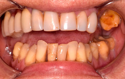 Зубы до имплантации