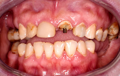 Фото до проведения имплантации зубов за 3 дня