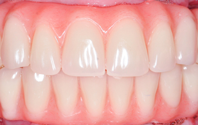 Проведено восстановление зубов с применением протокола комплексной имплантации