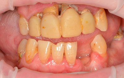 Фото до комплексной имплантации зубов