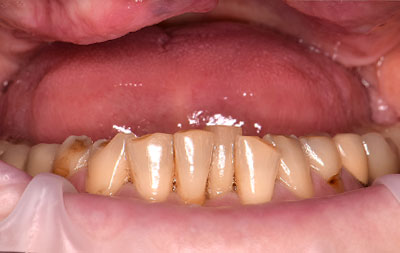 Фото состояния зубов пациента до операции