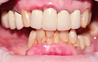 Подвижность зубов и мостовидных конструкций