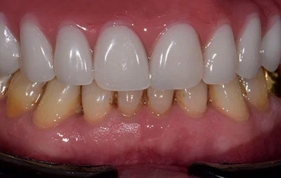 После восстановления зубов с помощью имплантов Straumann