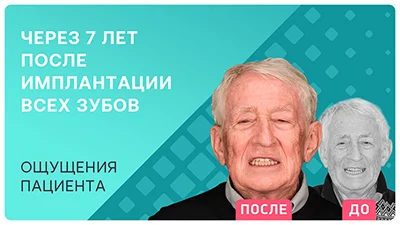 Видео - Имплантация всех зубов, ощущения пациента 7 лет спустя