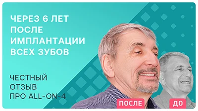 Видео - Через 6 лет после сложной имплантации зубов