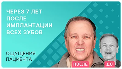 Видео - Честный отзыв об имплантации всех зубов 7 лет спустя