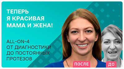 Видео - Итоги бесплатной имплантации Ольги Юрченко: новые зубы за 3 дня