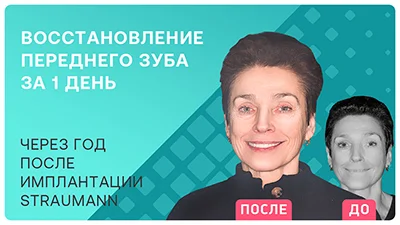 Видео - Имплантация Straumann и полное обновление улыбки коронками