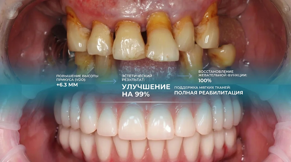 Пример восстановления зубов