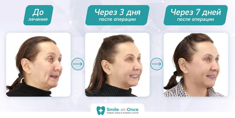 фото до и после операции по восстановлению зубов