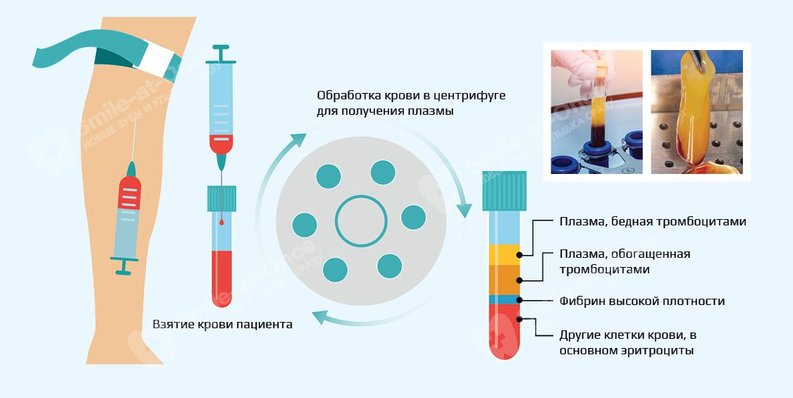 Как проводится плазмолифтинг в стоматологии как проводится плазмолифтинг в стоматологии