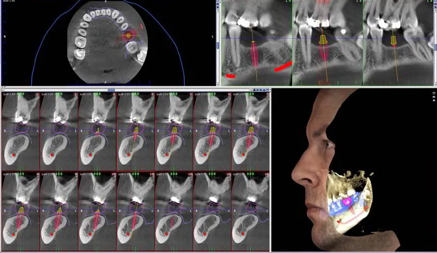 трехмерное моделирование имплантации зубов