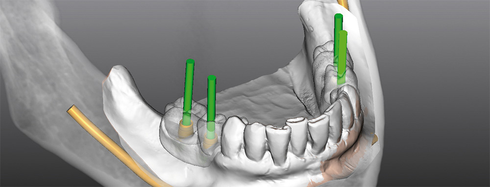 Создание 3d модели для имплантации Создание 3d модели для имплантации